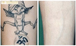  Rimozione laser pinerolo -Trattamento dei tatuaggi traumatici (con laser Q-SWITCH):